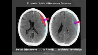 Subdural Hematoma SDH [upl. by Hallett]