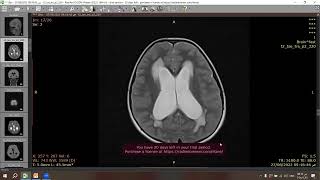 Pilocytic astrocytoma [upl. by Sophi]