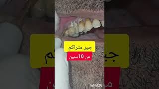 ازالة وتنظيف جير و تقليح الاسنان dentist stitch اكسبلور stitchlover ترند [upl. by Annerahs657]