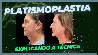 PLATISMOPLASTIA a técnica que elimina a papada [upl. by Mcilroy262]