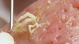 Blackheads amp Whiteheads Satisfying Removal 0078 [upl. by Horick315]