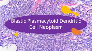 Blastic Plasmacytoid Dendritic Cell Neoplasm  learn in 10 minutes [upl. by Whatley246]