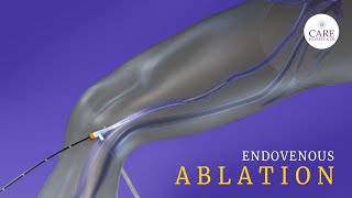 What is Endovenous Laser Ablation CARE Hospitals [upl. by Ches]