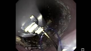 Endoscopic Suturing of Esophageal Stent  Mohamed Othman MD [upl. by Sheldon958]