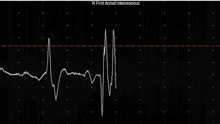 EMG teaching video 20 Myotonia [upl. by Nuri452]