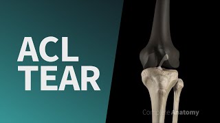 ACL Tear [upl. by Relly619]