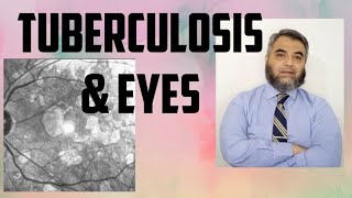 TUBERCULOSIS AND EYES Tuberculosis EyeinfectionRifampicinisoniazidethambutol [upl. by Artina]