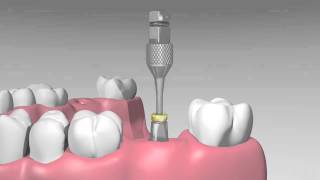 AIDI Biomedical  Abutment with Plastic Coping for Immediate Impression [upl. by Westmoreland]