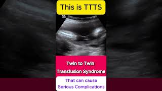 TTTS  Twin to Twin Transfusion Syndrome Ultrasound  Monochorionic TWINS [upl. by Aicilak]