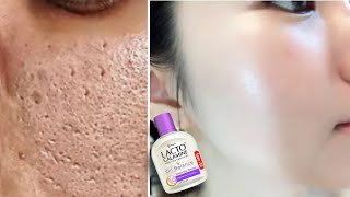 How to use Lacto Calamine Lotion  Lacto Calamine Lotion For Clear Spotless Brighten Skin [upl. by Aikemehs725]