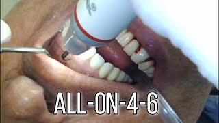 AllON46 teeth cleaning  scaling by dental hygienist [upl. by Nerin511]