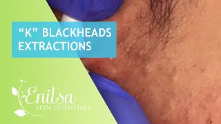 Blackheads Extractions “K’s” 2nd Treatment [upl. by Pratt]