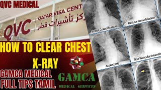 Chest xray  How to clear chest xray Gulf medical test  Qatar medical QVC medical Tamil Gamca [upl. by Halyahs]