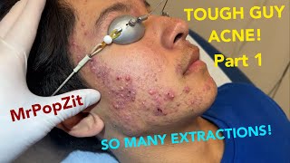 Severe hormonal acne in young patient So many clogged pores expressed Explosive inflammation [upl. by Carie7]