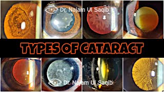 Types Of Cataract [upl. by Naleek]