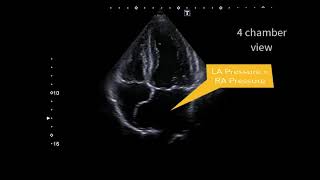 Atrial septal aneurysm [upl. by Airemahs]