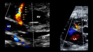 Echo assessment of coronary arteries in Kawasaki disease and fetal heart [upl. by Naihtniroc]