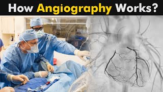 What is Angiography  How Coronary Angiography works UrduHindi [upl. by Nylqcaj]