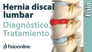 Hernia discal lumbar  Diagnóstico consejos ejercicios y tratamiento de fisioterapia [upl. by Neirual]