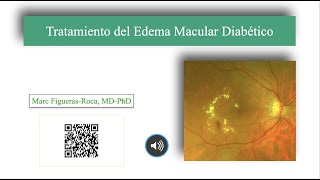 Tratamiento del Edema Macular Diabético [upl. by Ivanna]