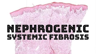 Nephrogenic systemic fibrosis from Gadolinium MRI contrast pathology dermatology dermatopathology [upl. by Aibun]