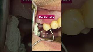 Periodontal Abscess  Loose Mobile Tooth  Gum swelling Tooth Infection tooth pain dentist [upl. by Koorb]