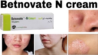 Betnovate n Skin care Cream How to use Benefits amp Side effects [upl. by Mathre380]