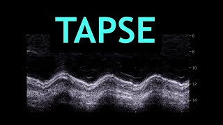 All about TAPSE Echocardiography [upl. by Yhtac]