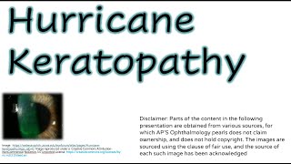 Hurricane Keratopathy [upl. by Claudell]