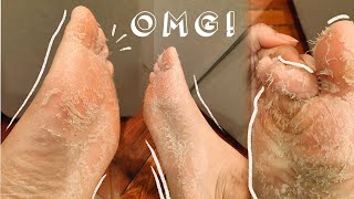 QUARANTINE SELF CARE  Foot Peel Mask in Self Isolation DID IT WORK [upl. by Rehpotsirhc]