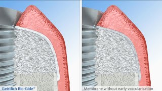 Early Vascularization with Geistlich BioGide® [upl. by Ydnyl]