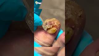 Huge toe callus callusremoval callusremoval footcare feetcare podiatry feet toes [upl. by Dviad]