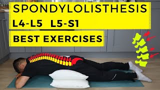 Spondylolisthesis treatment [upl. by Llenrep973]