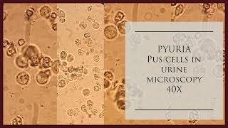 Pyuria Pus cells in urine microscopy at 40 X [upl. by Rehpotsirhcnhoj801]