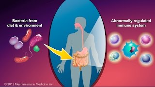 What is Crohns Disease [upl. by Soulier]