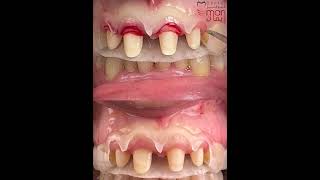 Surgical guide for gingiva Tommy and gingiviplasty [upl. by Seale]