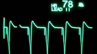 Ventricular Pacing [upl. by Walczak]