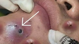 Big Cystic Acne Blackheads Extraction Blackheads amp Milia Whiteheads Removal Pimple Popping 012 [upl. by Maisey895]