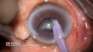 Phacoemulsification in an eye with non dilating small pupil [upl. by Yleik261]