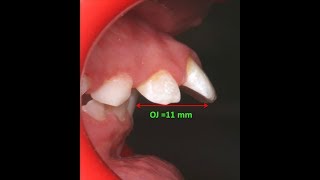 Amazing two phase treatment of Sever Class II Div 1  lama 10Y [upl. by Eriha440]