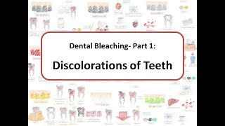 Dental Bleaching Part 1 Causes of Teeth Discolorations [upl. by Neilla]