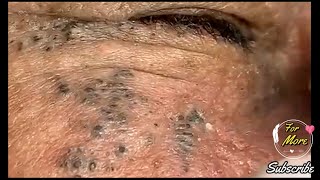 Dr Pop  Deep Blackheads in old Skin removing amp treatment 2020 Part 5 [upl. by Meeks329]