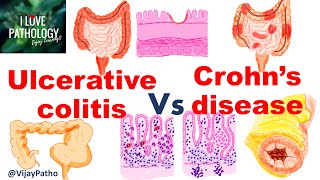 Ulcerative colitis Vs Crohns disease inflammatoryboweldisease [upl. by Lyrahc]