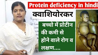 What is protein deficiency kwashiorkor in hindi  क्वाशियोरकर symptoms amp causes  ranjana [upl. by Assilana]