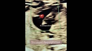 TRICUSPID REGURGITATION drnupurshah [upl. by Niveek]