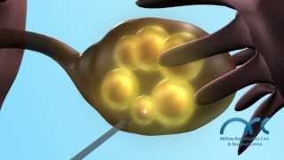 In Vitro Fertilization3D How to prepare a couple before IVF ICSI and improve success ARC Centre [upl. by Raff]