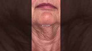 FasciaBlaster Before and After Neck photos  See the drastic difference [upl. by Mayeda807]