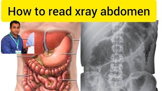 x ray of abdomen  x ray abdomen interpretation  x ray abdomen reading  abdomen radiology [upl. by Alrzc]