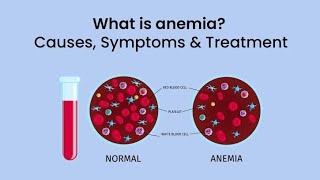 What is Anemia causes symptoms amp treatmentanemia trendingvideo trendingshorts medical [upl. by Titos153]