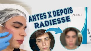 RADIESSE ANTES E DEPOIS [upl. by Aihseyk]